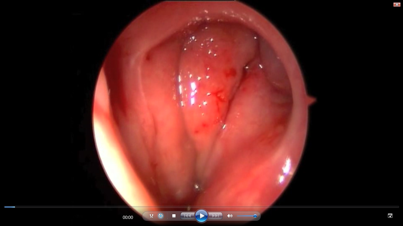 Fig.2.Ipertrofia del torus tubarius sinistro con stenosi tubarica, osservazione endoscopica angolata dalla fossa nasale controlaterale (preoperatorio)