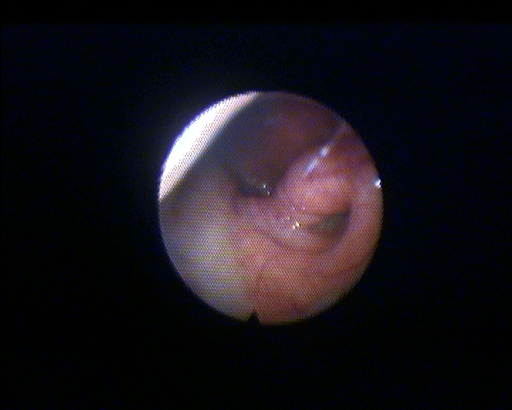 Fig.3.Risultato dopo 6 mesi dalla tubodilatazione, ostio pervio e torus normotrofico (postoperatorio)