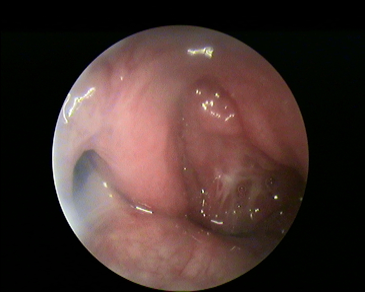 Fig.4.Risultati a distanza dopo tubodilatazione balloon, otio pervio e torus normotrofico