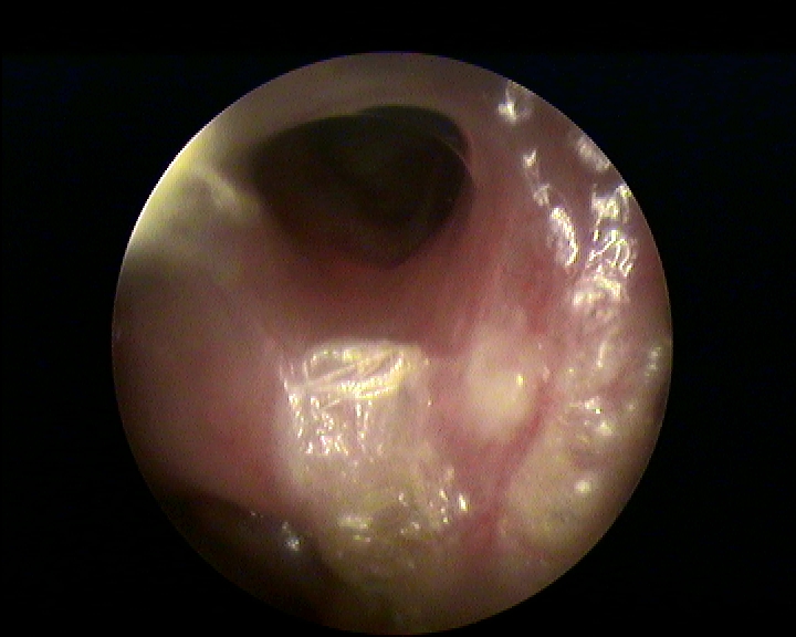 Fig.3: Ostio del seno frontale dilatato e ventilato dopo BSP
