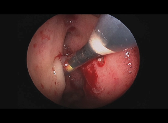 Fig.4: Dilatazione mascellare e infundibolare con balloon