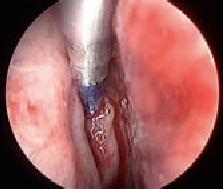 Fig.5: Perforazione bullare con Sinus Needle per inserimento dello stratus etmoidale
