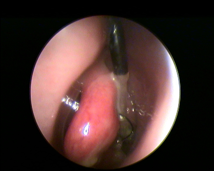 Fig.6:Stratus etmoidale inserito in sede