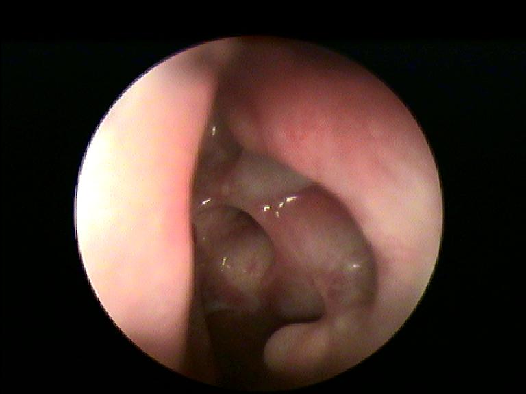 Fig.7: Esiti corretti di sinuplastica etmoidale con spacer etmoidale, neo ostio pervio, assenza di secrezioni.