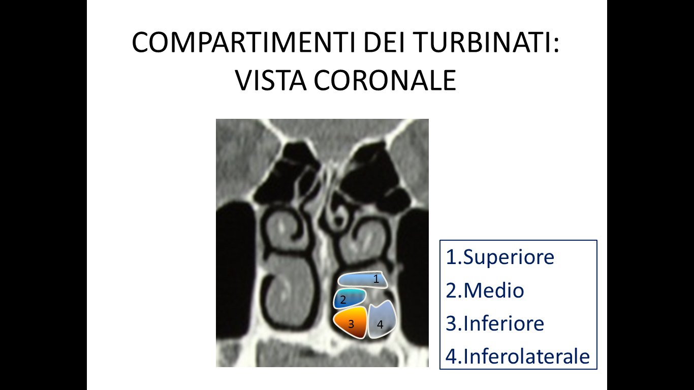 Fig.1 Classificazione compartimentale dei turbinati sezione coronale