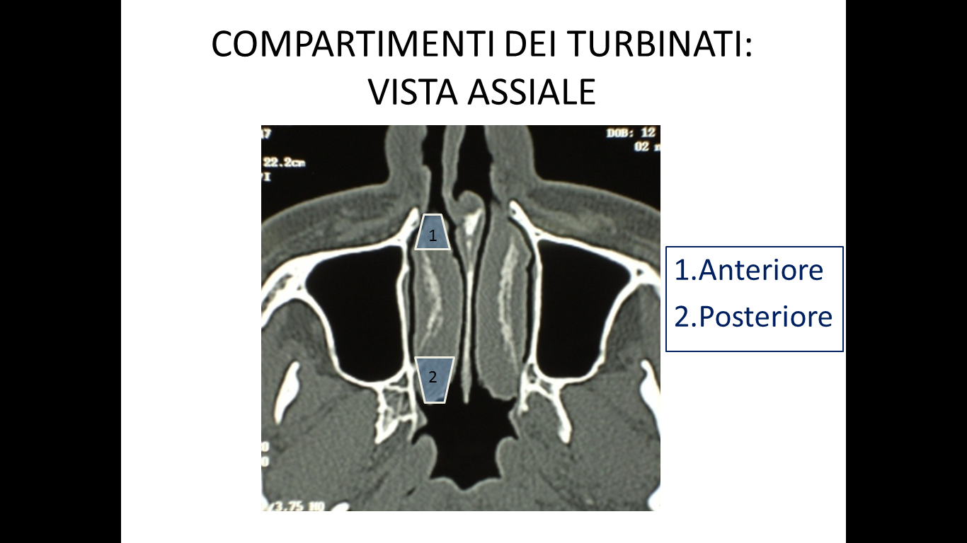 Fig.2 Classificazione compartimentale dei turbinati sezione assiale