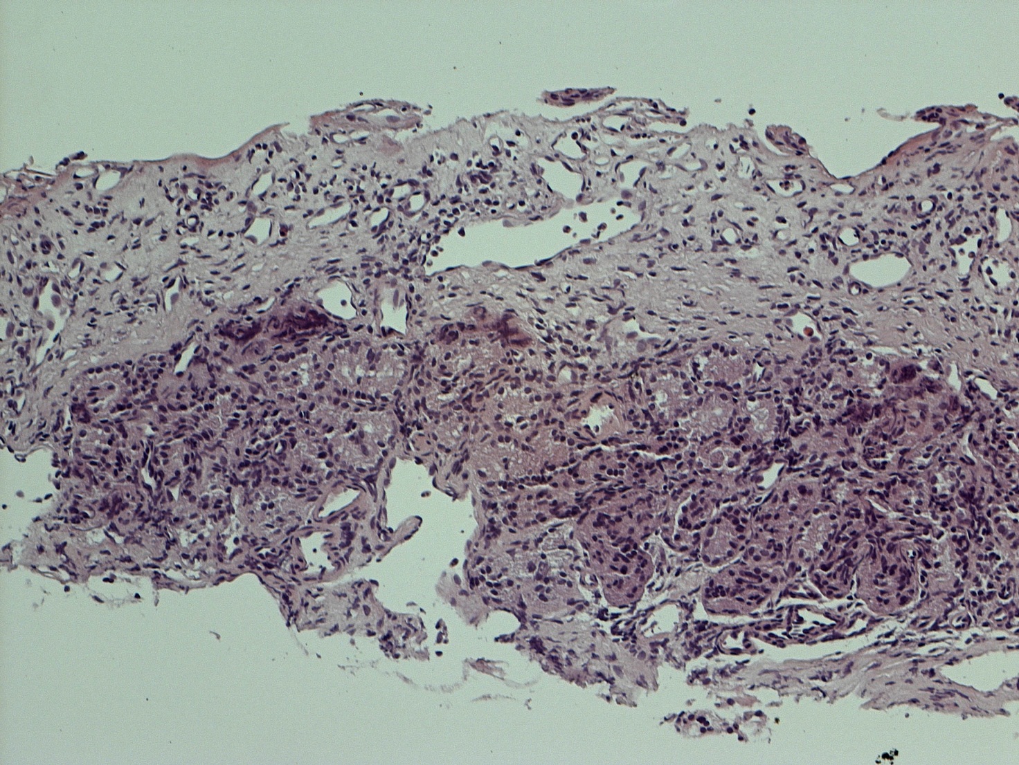 Fig. 3 Mucosa respiratoria di turbinato sede di pregressa turbinectomia con aree di focale metaplasia squamosa epiteliale, edema e modificazioni infiammatorie a livello della lamina propria (Ematossilina-Eosina)