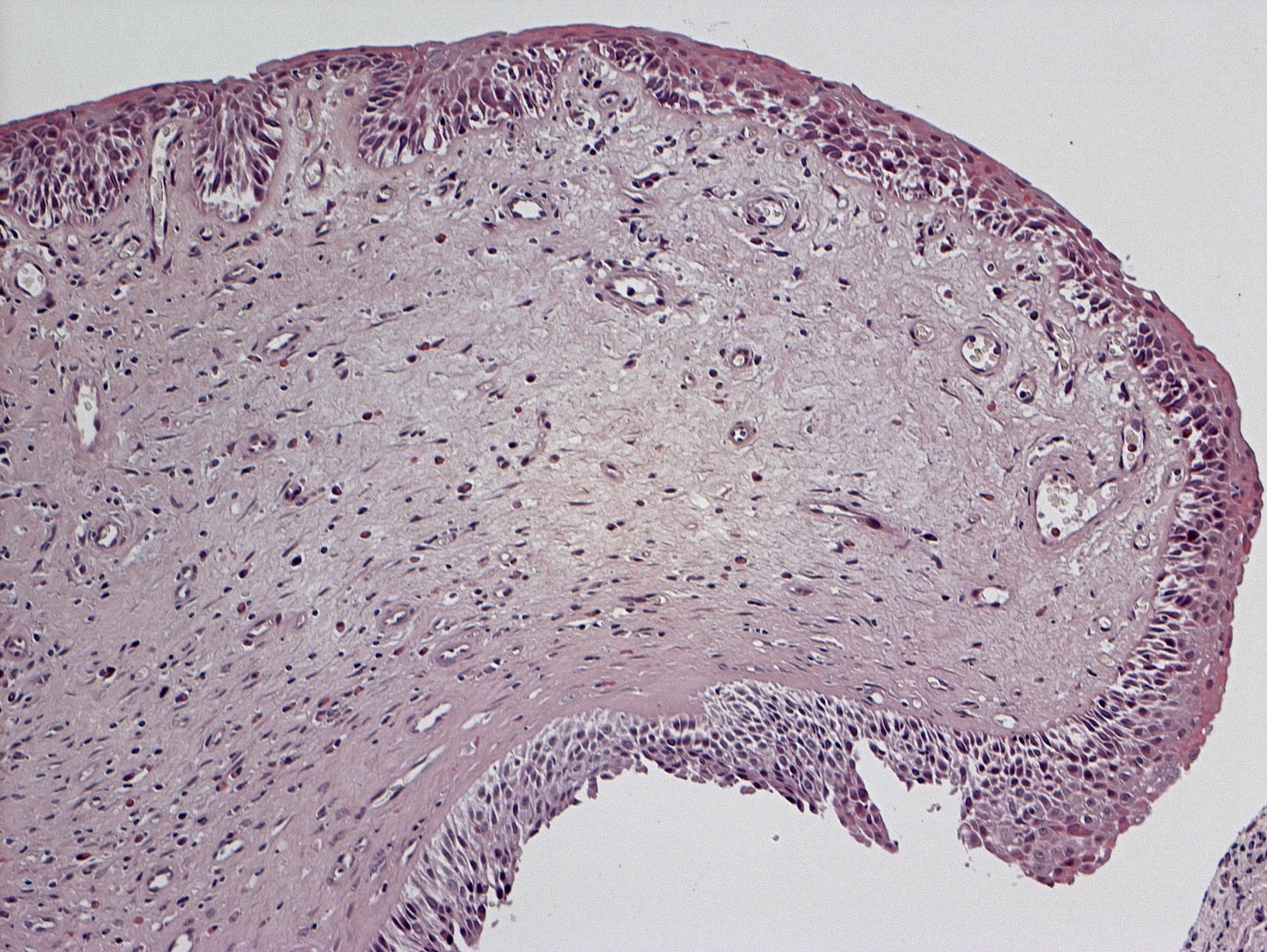  Fig. 4 Mucosa respiratoria di turbinato dopo ricostruzione con PRL con aree di epitelio denudato, fibrosi diffusa della lamina propria, iperplasia microvascolare e focale infiltrazione linfocitaria (Ematossilina-Eosina)